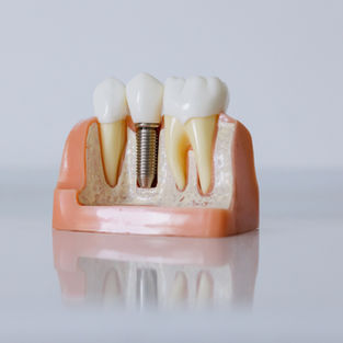 Protesi fissa in zirconia/ceramica su modello master, realizzazione di corone e ponti per riabilitazione su denti naturali o impianti.
