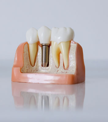 Root Canal