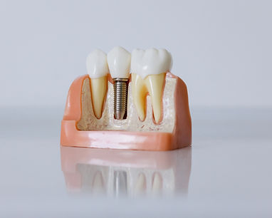 Dental Implant Model