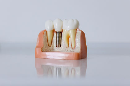 Canal radicular