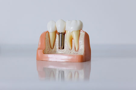 Dental implant model with crown, abutment and post at Danbury Bright Smiles