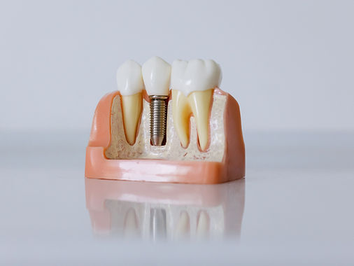 Dental implant model showing titanium post and crown used for missing tooth replacement at Dental Capital SE in Oakleigh