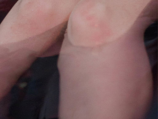 ¿Qué es la artritis reumatoide?