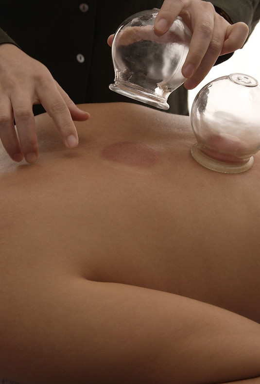 Cupping Treatment in Lilydale for back pain and musle tension