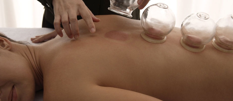 Massage Cupping Story