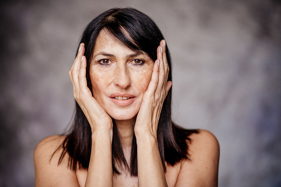 Woman With Vitiligo