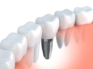 Illustration of a dental implant in a row of teeth