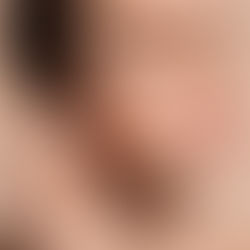 botox filler beauty holiday ready