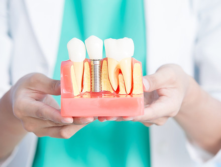 woman dentist take implant tooth