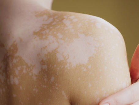 การรักษาผื่นภูมิแพ้ทางผิวหนัง