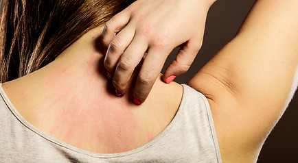 Allergic Reaction