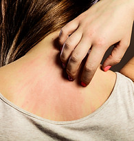 Allergic Reaction