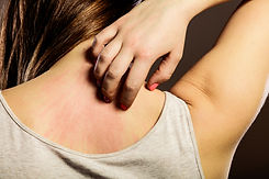 Allergic Reaction