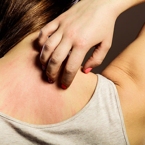 Allergic Reaction