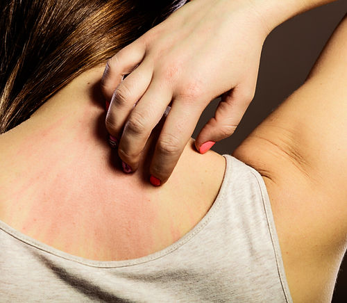 Allergic Reaction