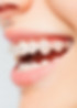 Sonriendo con brackets