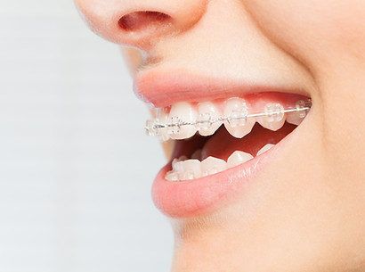 Braces Smile