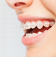 Smiling With Braces