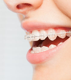 Braces Smile