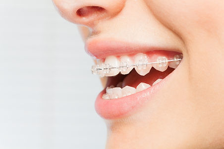 Bretelle Smile