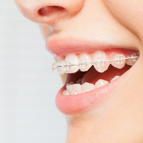 Suspensórios sorriso