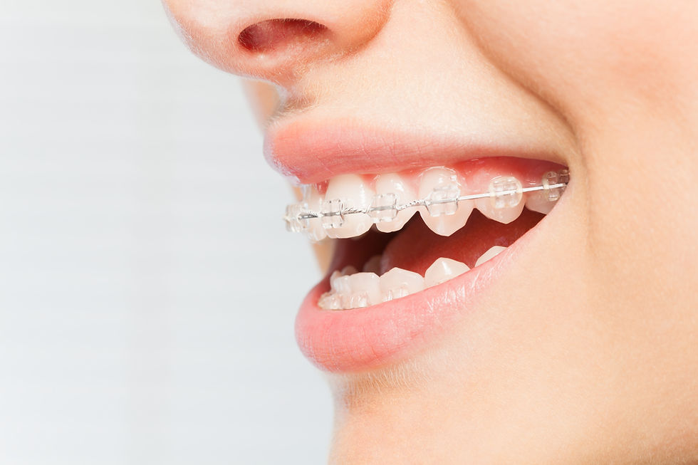 Sonriendo con brackets