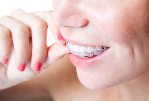 Clear Braces