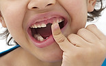 Fallen Tooths