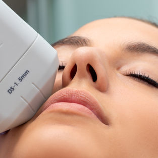 O ultrassom microfocado e o macrofocado são tecnologias de tratamento da pele que usam ondas sonoras de alta intensidade. A principal diferença entre os dois é a profundidade de penetração na pele. 
Ultrassom microfocado
O ultrassom microfocado é indicado para tratamentos faciais, principalmente aqueles que visam o rejuvenescimento facial. Isso porque, ao contrário do macrofocado, ele conseguirá atingir com a precisão necessária o SMAS e, por consequência, estimular a retomada na produção de colágeno. Como resultado, é perceptível o efeito de lifting instantâneo que irá se consolidar com o passar dos meses, já que os efeitos são progressivos.
