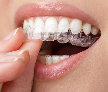 Şeffaf plak ortodonti – Clear aligner tedavisi