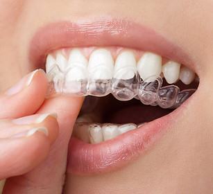 Clear Aligner Use