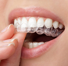 Clear Dental Aligner