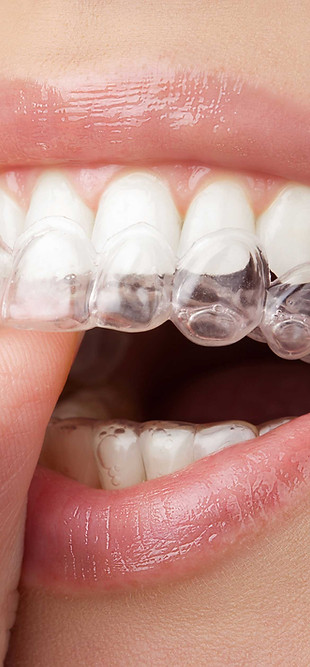 Aligneur dentaire transparent