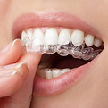 Alineador dental transparente
