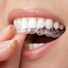 Clear Dental Aligner