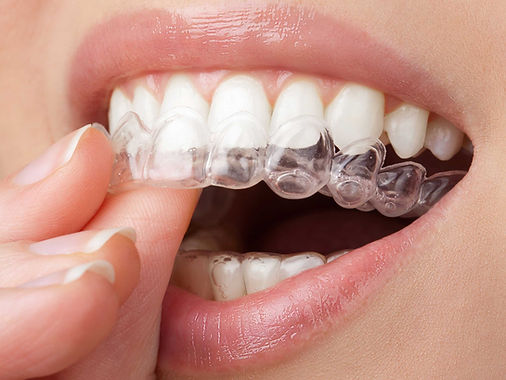Patient inserting clear aligner tray for orthodontic teeth straightening at Dental Capital SE in Oakleigh.