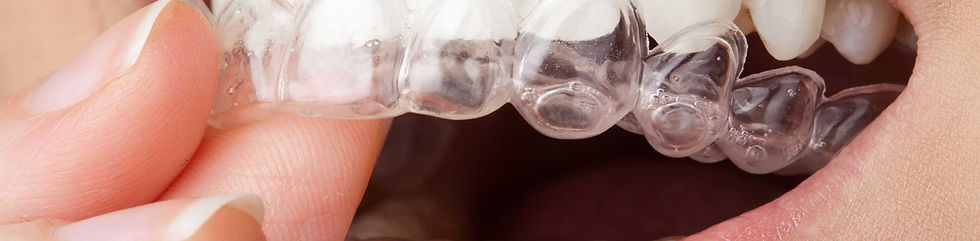 Gebruik van transparante aligners
