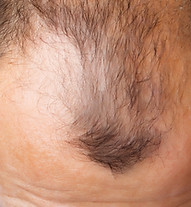 Middle aged man with hair loss, shot from above