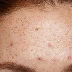 Woman With Acne