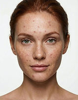 Acne treatment at Herrington Aesthetics in Huntsville, AL