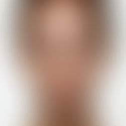 Acne adolescenziale sul viso di giovane donna