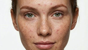 women with acne 