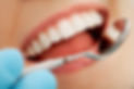 Close-up of patient's teeth during a check-up