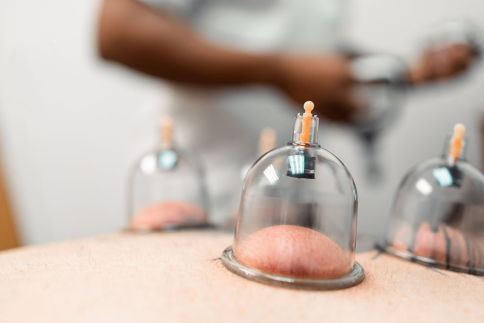 Cupping Therapy