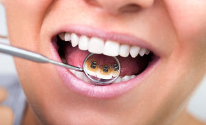 Dental Braces Closeup