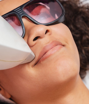 Bovenlip laserontharing