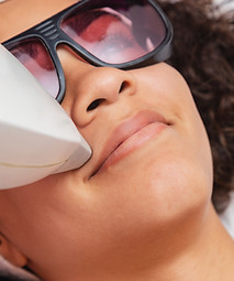 Upper Lip Laser Hair Removal