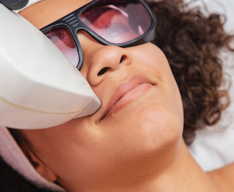 Upper Lip Laser Hair Removal