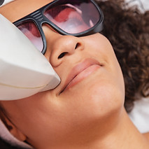 Upper Lip Laser Hair Removal
