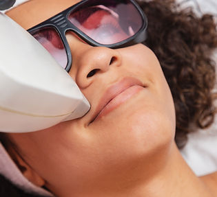 Bovenlip laserontharing
